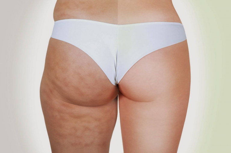 Mesoterapia