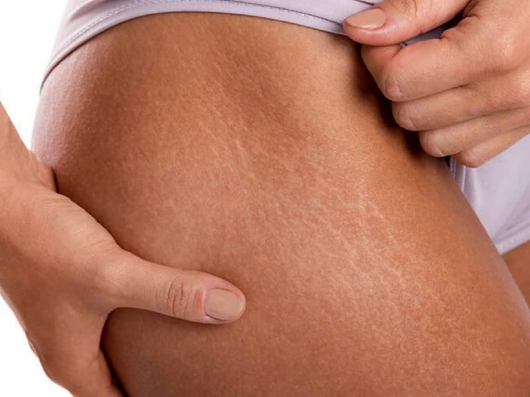 eliminare le smagliature corpo