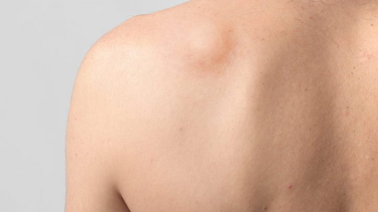 lipoma