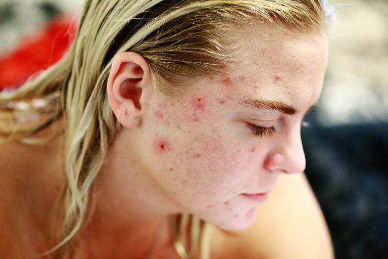 acne come curarla