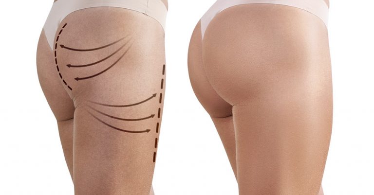 Gluteoplastica mini invasiva, cos’è e quali sono i benefici