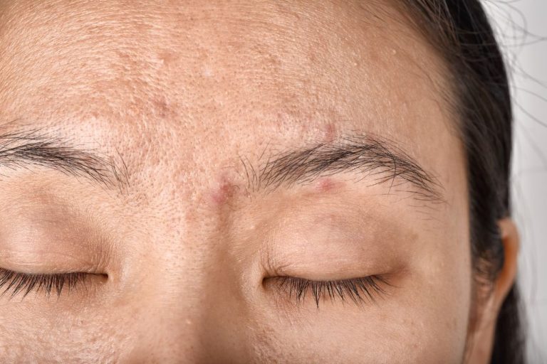 Stress e pelle: come gestire gli effetti negativi